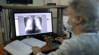 1192 жителей Красноярского края заболели туберкулезом в прошлом году